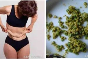 美女吃素減肥三個月，取出200多顆膽結石！