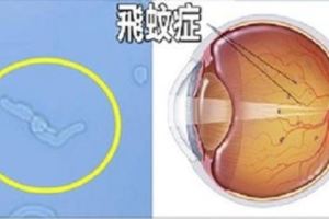 「飛蚊症」無法根治的殘酷真相，教你延緩玻璃體老化的飲食療法！