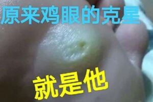 原來治療雞眼那麼簡單，不到一個星期全好啦