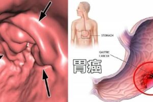 醫生提醒：早晨空腹時千萬別碰這2種食物，會損傷胃粘膜，並加重原有的胃痛！