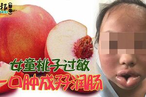 女童桃子過敏一口腫成孖潤腸