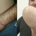 這位男子原本被迫要截肢，但醫生把他的「左手縫進肚子裡」，42天後竟出現奇蹟般的結果！