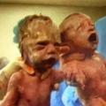 當這對雙胞胎從媽媽肚子裡生出來的那一瞬間，竟讓醫院所有人都震驚了！