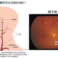 警惕！中老年人視網膜動脈阻塞的早期信號！可造成永久失明！