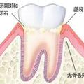 牙齒也會得「結石」？嚴重了竟然要拔牙？