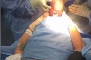 媽媽親手把「雙胞胎寶寶」從腹中拉出！醫生們都為她的勇氣感到佩服。