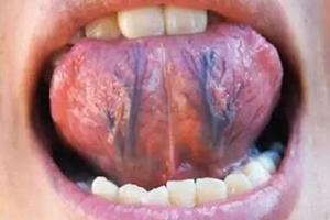 血管堵不堵，看看舌頭就知道了！火麻仁泡水喝，除淤通血不堵塞！