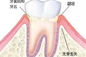 牙齒也會得「結石」？嚴重了竟然要拔牙？