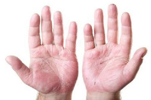 秋季手掌脫皮是乾燥惹的禍？有可能預示著身體出現這4種疾病！