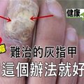 難治的灰指甲用這一個辦法就好了 