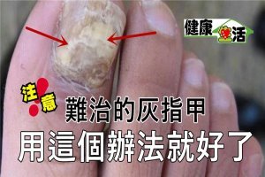 難治的灰指甲用這一個辦法就好了 