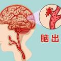 58歲男子，深夜突發腦出血癱瘓！提醒中老年人：儘量少做這4件事