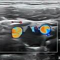 內外夾擠，仍瘤有餘地——頸動脈體瘤超聲診斷