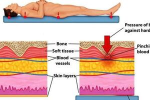 長期臥床人群必看：褥瘡的典型症狀有哪些？