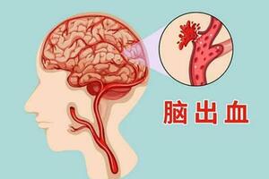 58歲男子，深夜突發腦出血癱瘓！提醒中老年人：儘量少做這4件事