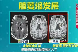 30歲的人80歲的大腦，《我是大醫生》帶您了解易被忽視的腦缺氧！