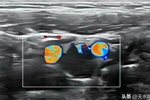 內外夾擠，仍瘤有餘地——頸動脈體瘤超聲診斷