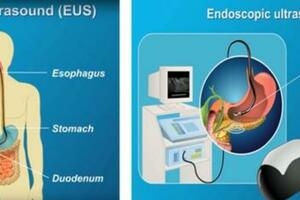 超聲內鏡，給你一雙探查胃腸道的「透視眼」