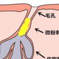 讓你抓狂的閉合型粉刺該何去何從