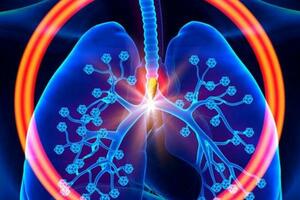 肺癌患者血常規指標特徵分析