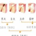 粉刺、黑頭的處理方法