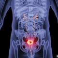 老年男性最常見的惡性腫瘤膀胱癌，怎麼治療？
