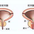 前列腺炎，這個老方有奇效，但有幾類人不適用