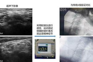 蘭大二院疼痛科成功開展超聲導航下椎間孔入路背根神經節射頻調控術