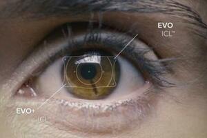 「眼內鏡ICL」，為近視朋友提供摘鏡新選擇