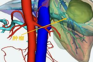 男子體檢查出肝腺瘤，醫生戴上AR眼鏡精準切瘤