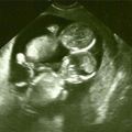 產檢時發現懷的是「連體嬰」，她仍堅持要生下來，當孩子出生的那一刻…大家都紅了眼眶！ 
