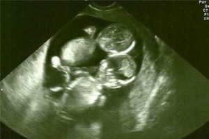 產檢時發現懷的是「連體嬰」，她仍堅持要生下來，當孩子出生的那一刻…大家都紅了眼眶！ 