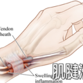「媽媽手」發作時不但手指無力，肌腱受損更是後患無窮，「5個動作」自救肌腱不求人。