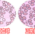 經常性掉髮、心悸、頭暈？全是「缺鐵性貧血」惹的禍：五種「補鐵食物」這樣吃，遠離「貧血人生」不用等！