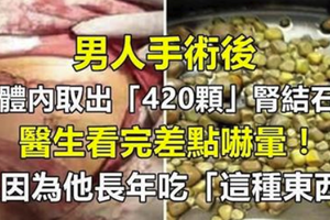 男人手術後從體內取出「420顆」腎結石...醫生看完差點嚇暈！只因為他長年吃「這種東西」。