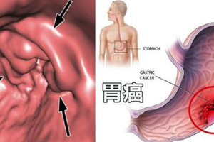 腹脹、噁心非小事！「四種症狀」恐是「胃癌」早期警訊，破壞「胃黏膜」的元兇竟是它！