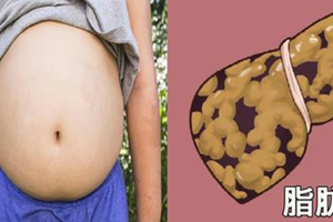 患「脂肪肝」不忌口，當心糖尿病、「肝癌」都來找！營養專家揭開「四大原則」保肝、戰勝脂肪