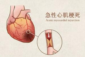 遇見心肌梗死不要慌，做對這些才能最大概率成功自救！