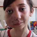 她6歲時發現罹患罕見病症導致「半邊臉畸形」，結果不能去上學的她竟然都在家做這些…太強大了！