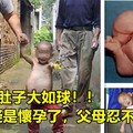 1歲女寶肚子大如球，醫生懷疑是懷孕了，父母忍不住大哭！