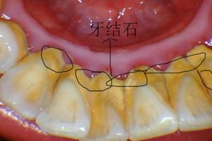 洗牙真的是条不归路？到底洗还是不洗的好？