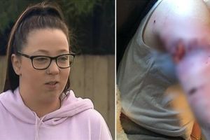 20歲澳女被2惡犬攻擊　狂咬30下縫60針狗主拒絕道歉