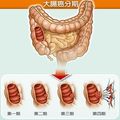 大腸癌高居癌症之首 因「沒有症狀就是症狀」