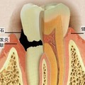 究竟應不應該定期「洗牙」，讓專家解開你多年的疑惑！