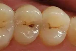快檢查一下你的牙齒，上面小黑點原來這麼可怕！