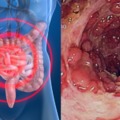 莫名拉肚子的人千萬注意！這種「排便形狀」是腸癌的高危險徵兆！超過這個年齡的人更要提高200%警覺！