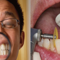 「磨牙」完全不是你想的一回事！它是「這種病」的發病徵兆！再不治難纏終身！
