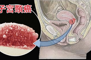 「子宮頸癌」有救了！這個我們「常吃的菜」竟可殺死多它100倍的子宮頸癌細胞！！一定要分享出去！