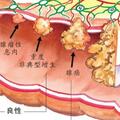 忽視一個細節，切了「息肉」也可能患癌……