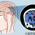 為啥中國腦梗死患者越來越多？廚房裡的3種調料濫用或是「幫凶」